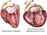 Диабетическая кардиомиопатия