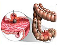 Дивертикулы кишечника