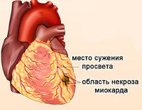 Микроинфаркт (Мелкоочаговый инфаркт миокарда)
