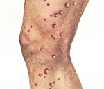 Папулонекротический туберкулез кожи