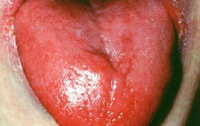 Пернициозная анемия