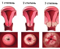 Рак шейки матки при беременности