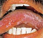 ВИЧ-инфекция полости рта: ВИЧ-инфекция полости рта