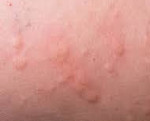 Генитальная аллергия: Генитальная аллергия