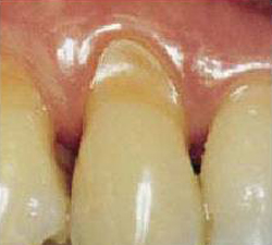 Гиперестезия зубов: Гиперестезия зубов