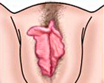 Гипертрофия малых половых губ: Гипертрофия малых половых губ