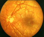 Гипоплазия зрительного нерва: Гипоплазия зрительного нерва