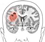 Глиома головного мозга: Глиома головного мозга