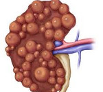 Гломеруоцитоз почек гипопластического типа: Гломеруоцитоз почек гипопластического типа
