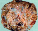 Гранулезоклеточная опухоль яичника: Гранулезоклеточная опухоль яичника