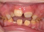 Дефекты зубных рядов: Дефекты зубных рядов