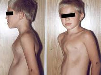 Деформации грудной клетки у детей: Деформации грудной клетки у детей