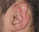 Деформация ушных раковин