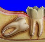 Дистопированный зуб: Дистопированный зуб