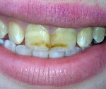 Заболевания твердых тканей зуба
