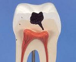 Лечение кариеса постоянных зубов реферат