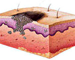 Злокачественные опухоли кожи
