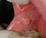 Злокачественные опухоли полости рта