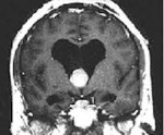Коллоидная киста III желудочка – новообразование округлой формы, которое располагается в полости III желудочка головного мозга. Не является раковой опухолью, не метастазирует, но способно к росту. Опасность для пациента заключается в перекрытии путей циркуляции ликвора с развитием гидроцефального синдрома.