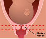 Короткая шейка матки при беременност