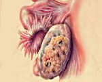 Метастатический рак яичников: Метастатический рак яичников