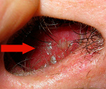 Микозы носа и околоносовых пазух: Микозы носа и околоносовых пазух