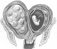 Литература по миоме матки при беременности thumbnail