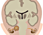 Невринома слухового нерва: Невринома слухового нерва