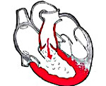 Недостаточность клапана легочной артерии: Недостаточность клапана легочной артерии