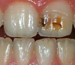 Некариозные поражения зубов: Некариозные поражения зубов