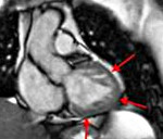 Некомпактный миокард левого желудочка: Некомпактный миокард левого желудочка (Губчатая кардиомиопатия, Губчатый миокард)