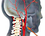 Окклюзия сонных артерий