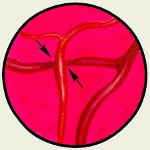 Окклюзия центральной артерии сетчатки: Окклюзия центральной артерии сетчатки