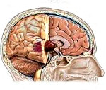 Опухоли головного мозга: Опухоли головного мозга