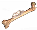 Опухоли костей (Новообразования костей): Опухоли костей (Новообразования костей)