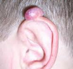 Опухоли уха: Опухоли уха