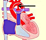 Открытый артериальный проток: Открытый артериальный проток