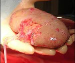 Отторжение почечного трансплантата: Отторжение почечного трансплантата