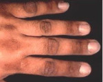 Паранеопластические дерматозы (Паранеоплазии кожи, Параонкологические дерматозы)