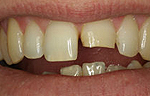 Перелом зуба: Перелом зуба