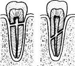 Перелом корня зуба: Перелом корня зуба