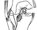 Перелом мыщелков большеберцовой кости: Перелом мыщелков большеберцовой кости