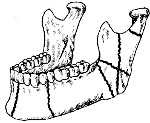 Перелом нижней челюсти: Перелом нижней челюсти