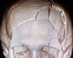 Перелом свода черепа: Перелом свода черепа
