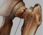 Перелом шейки бедра (Перелом шейки бедренной кости): Перелом шейки бедра (Перелом шейки бедренной кости)