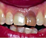Пигментация зубов: Пигментация зубов