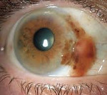 Пигментная глаукома: Пигментная глаукома