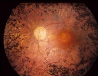 Пигментный ретинит: Пигментный ретинит