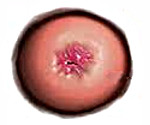 Плоскоклеточный рак шейки матки: Плоскоклеточный рак шейки матки