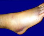 Повреждение связок голеностопного сустава: Повреждение связок голеностопного сустава